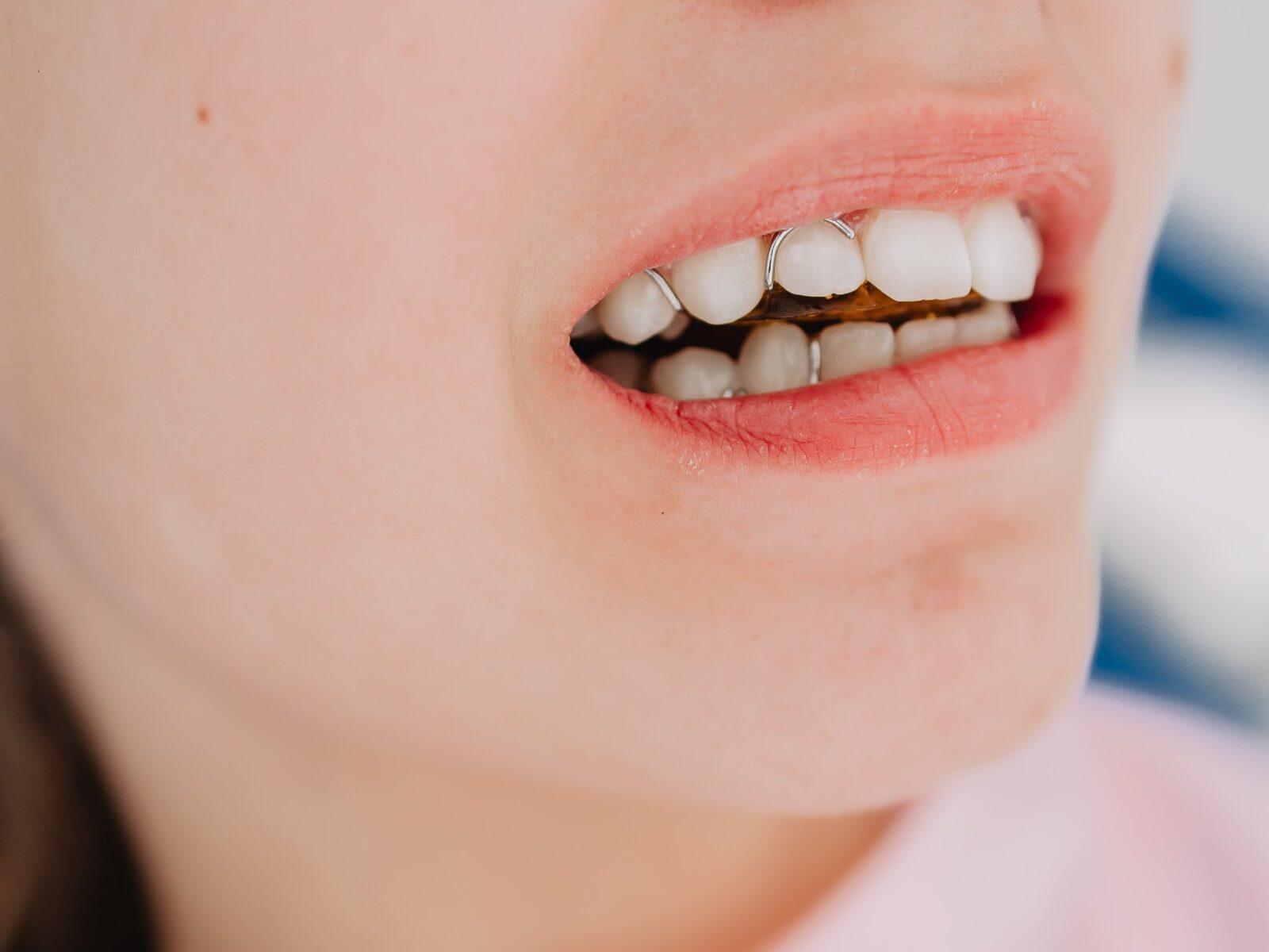 Ретейнеры: что это и зачем нужны
